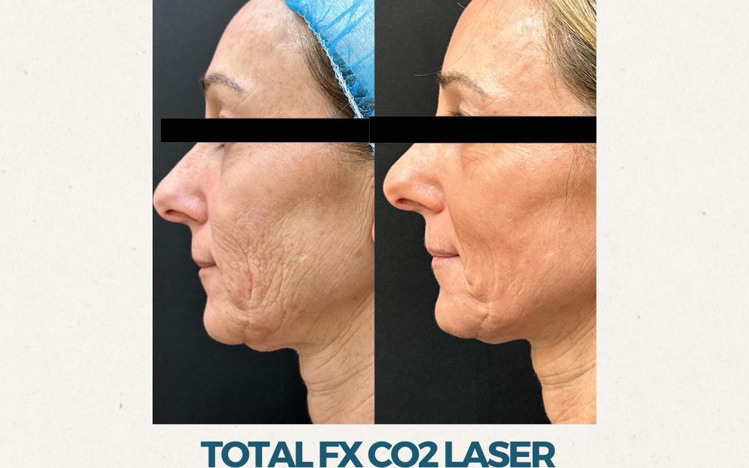 FLASH SALE – Save $1000 on Total FX Laser Skin Resurfacing