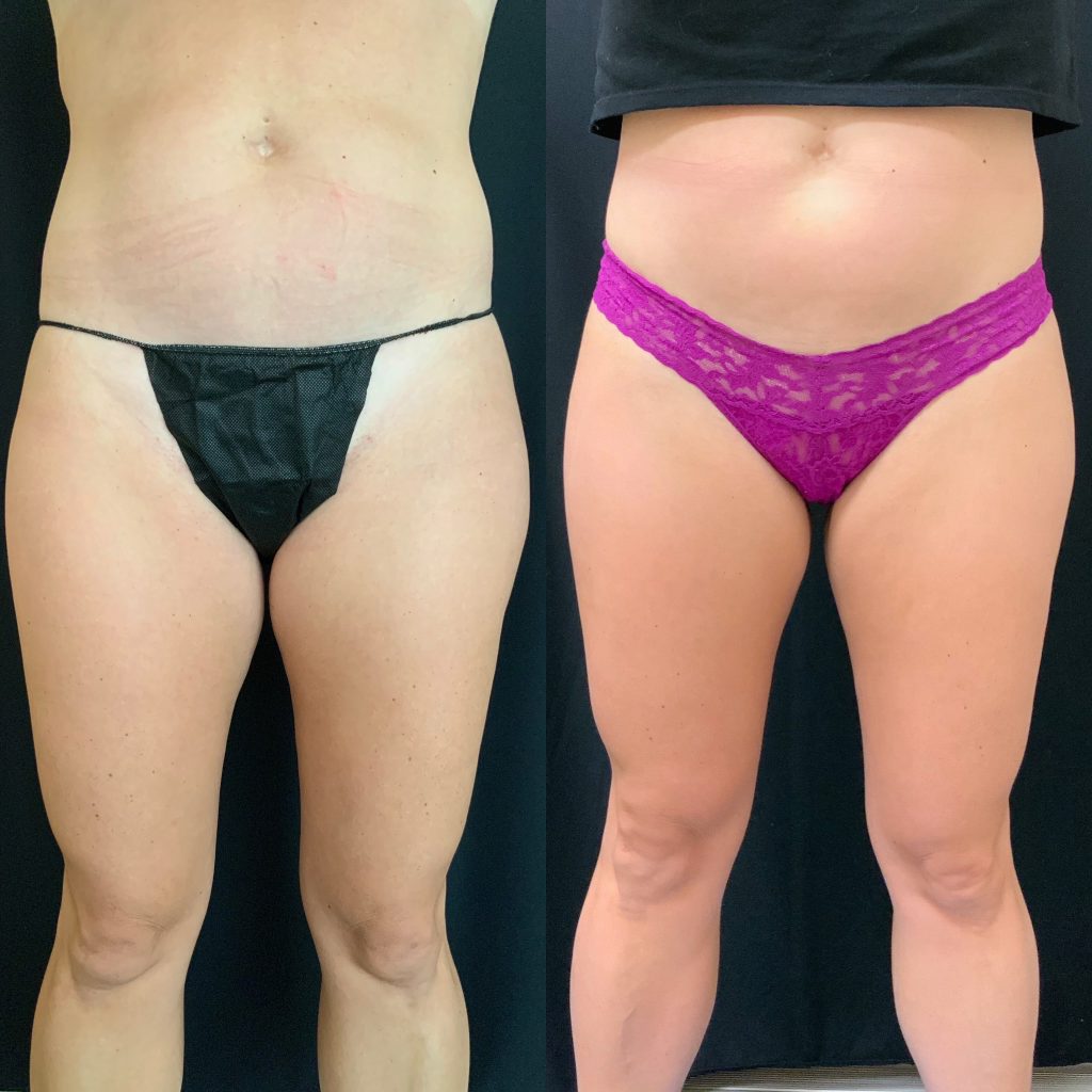 Before-and-After-CoolSculpting-Inner-Thighs