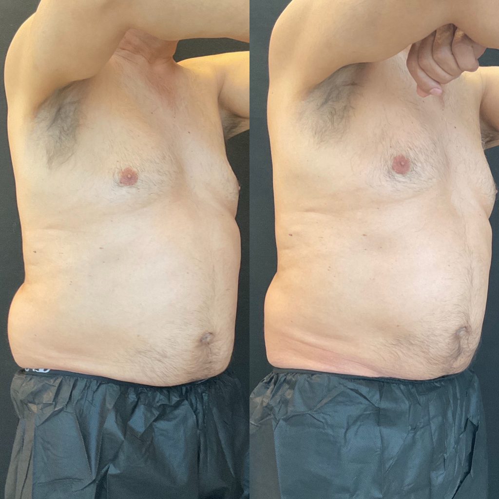 Scottsdale-coolsculpting-for-men