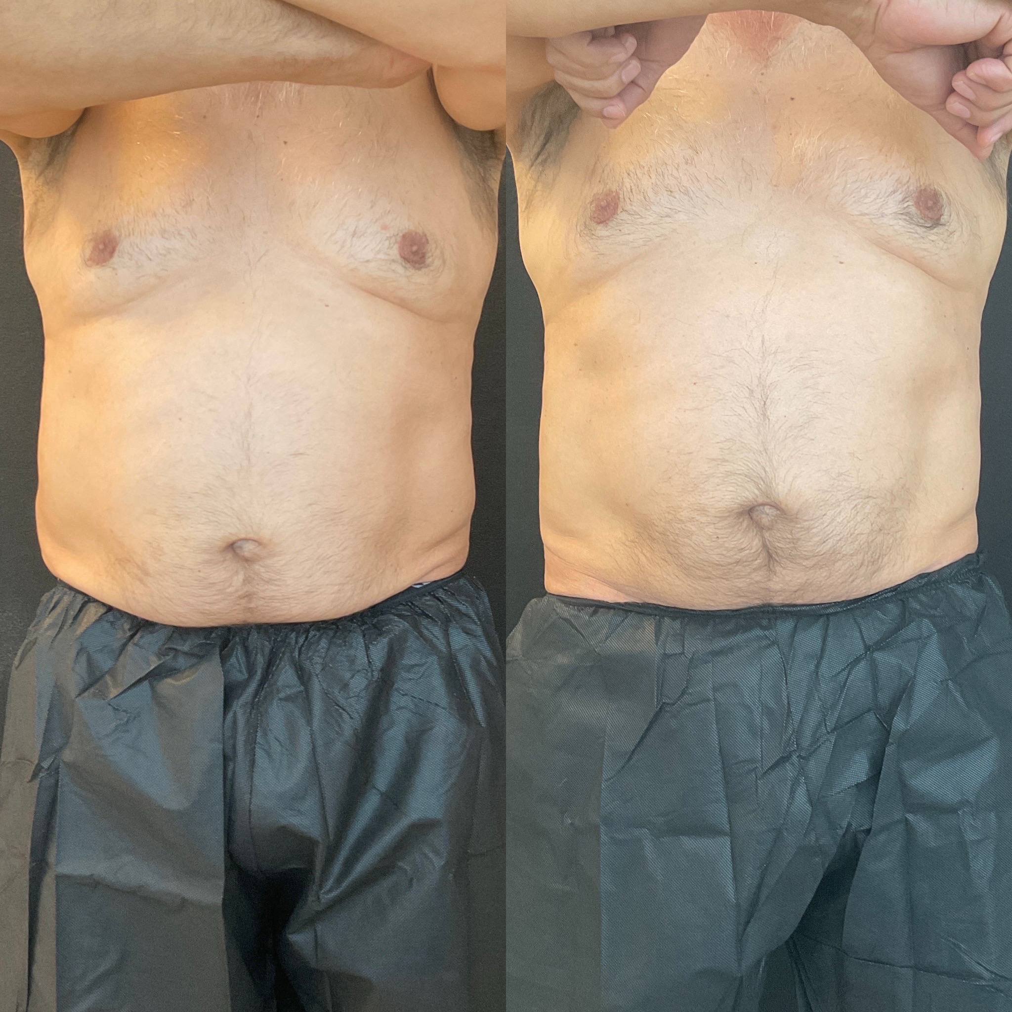 Abdomen-and-flanks-coolsculpting-before-and-after