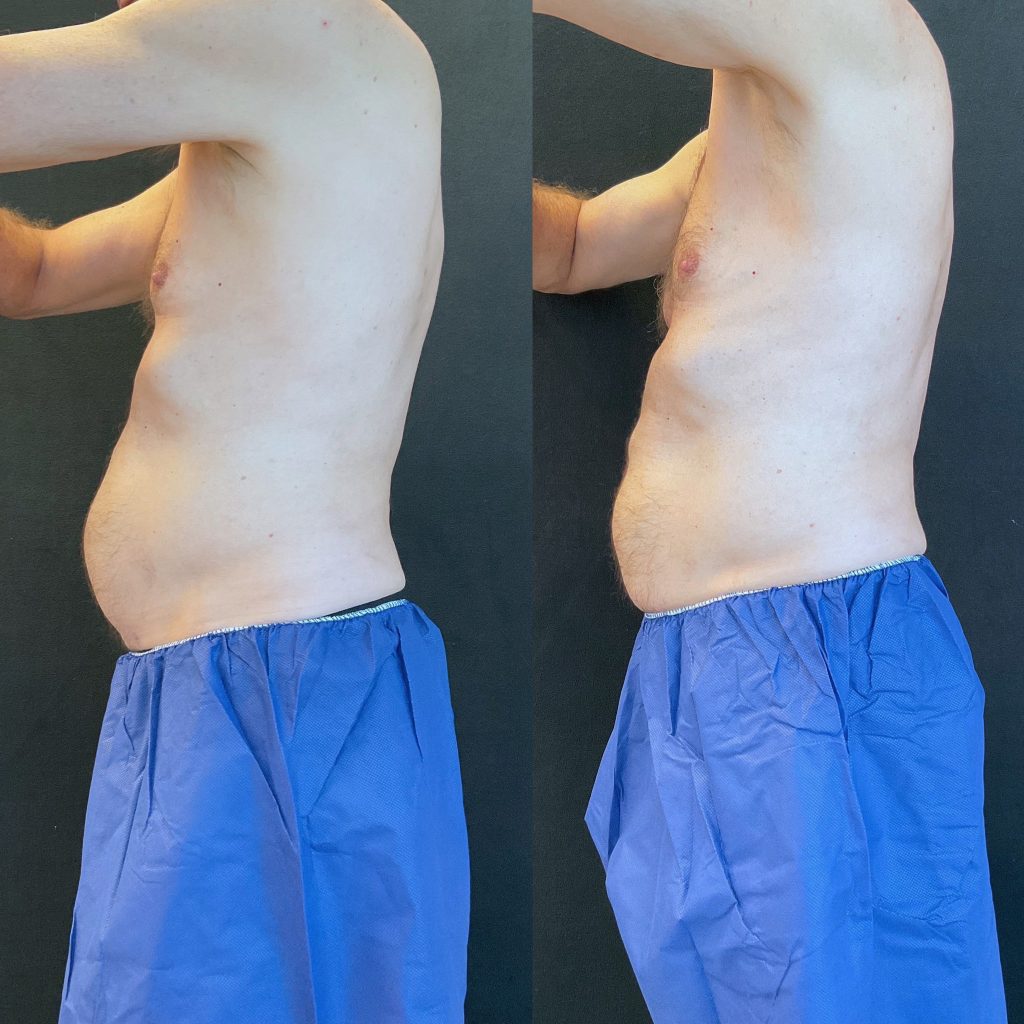 before-and-after-coolsculpting-for-men-scottsdale