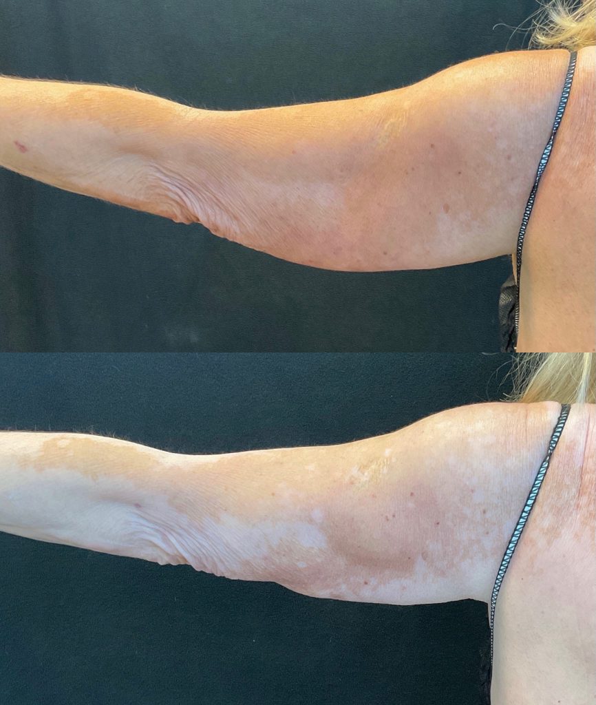 before-and-after-coolsculpting