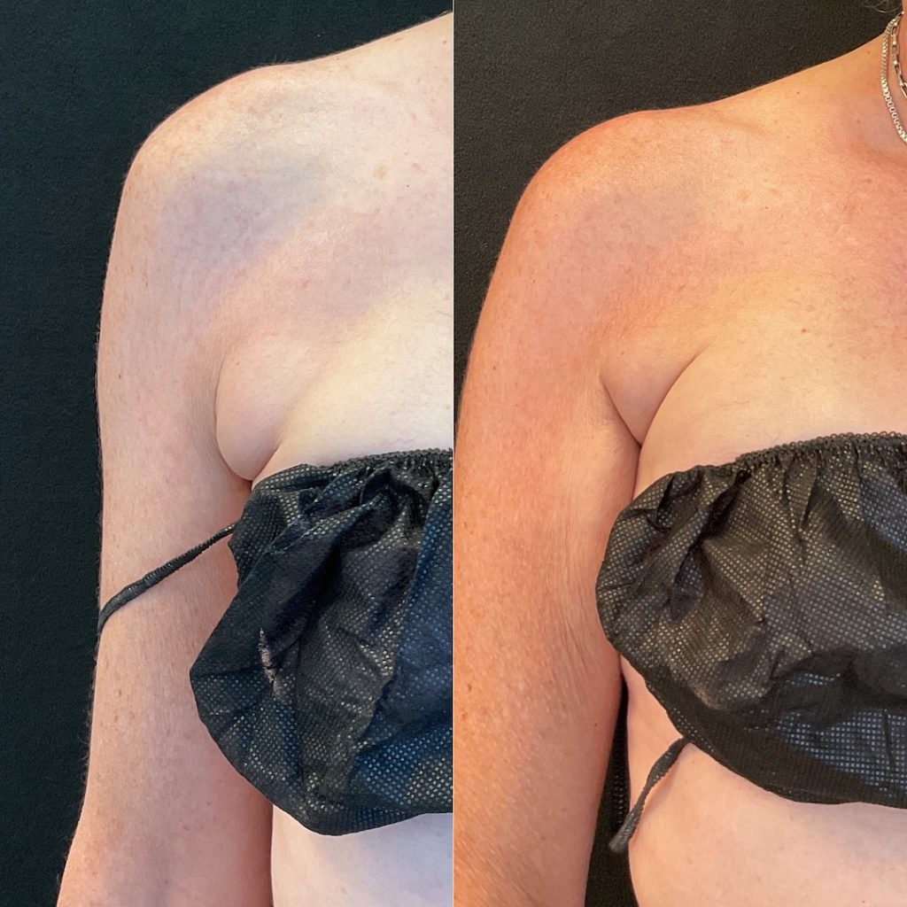 before-and-after-bra-fat-coolsculpting