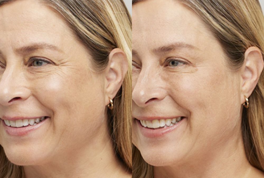 How Botox Can Improve Your Facial Features