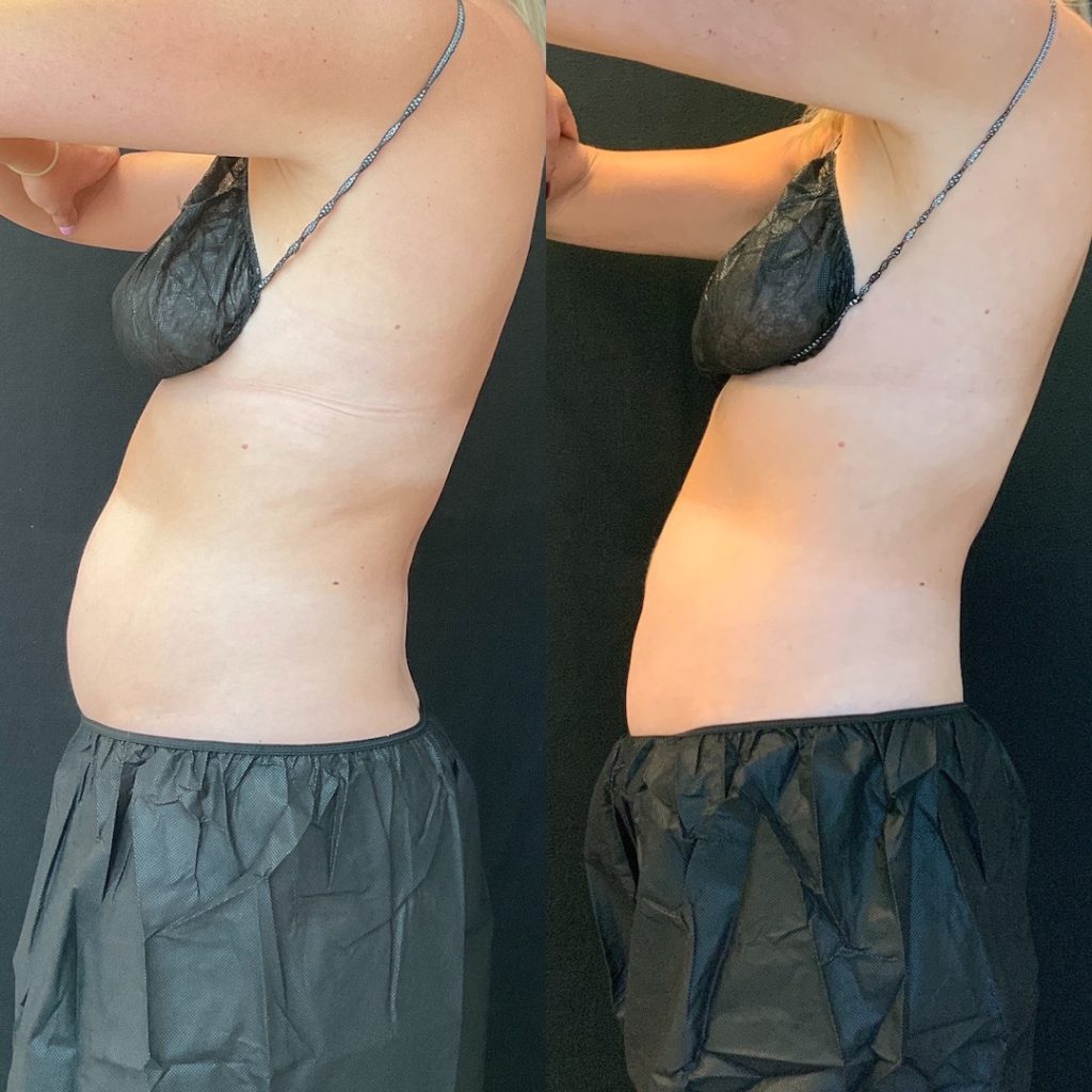 CoolSculpting-stomach after-two-sessions-before-and-after