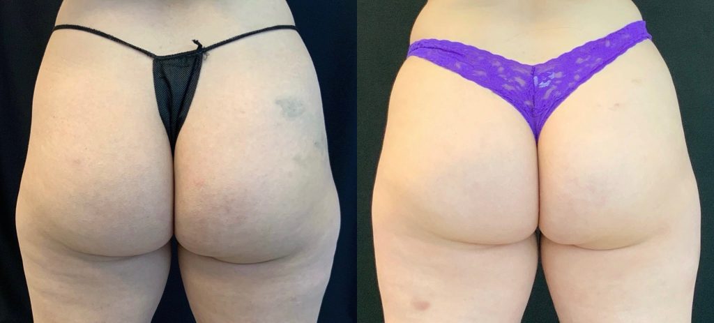 coolsculpting-before-and-after-outer-thighs