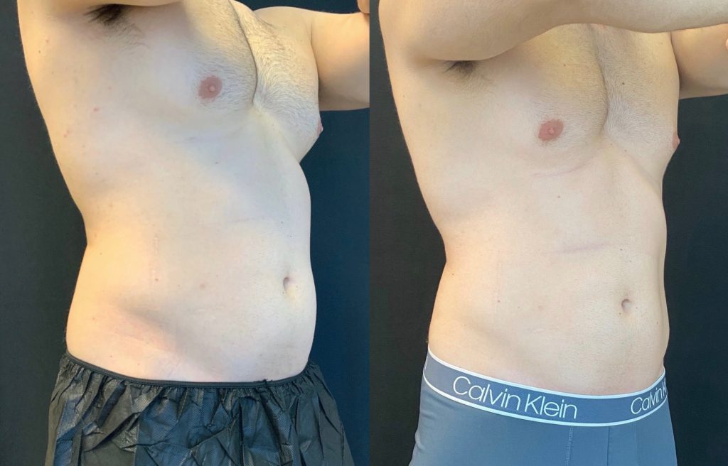 Does CoolSculpting Work For Men?