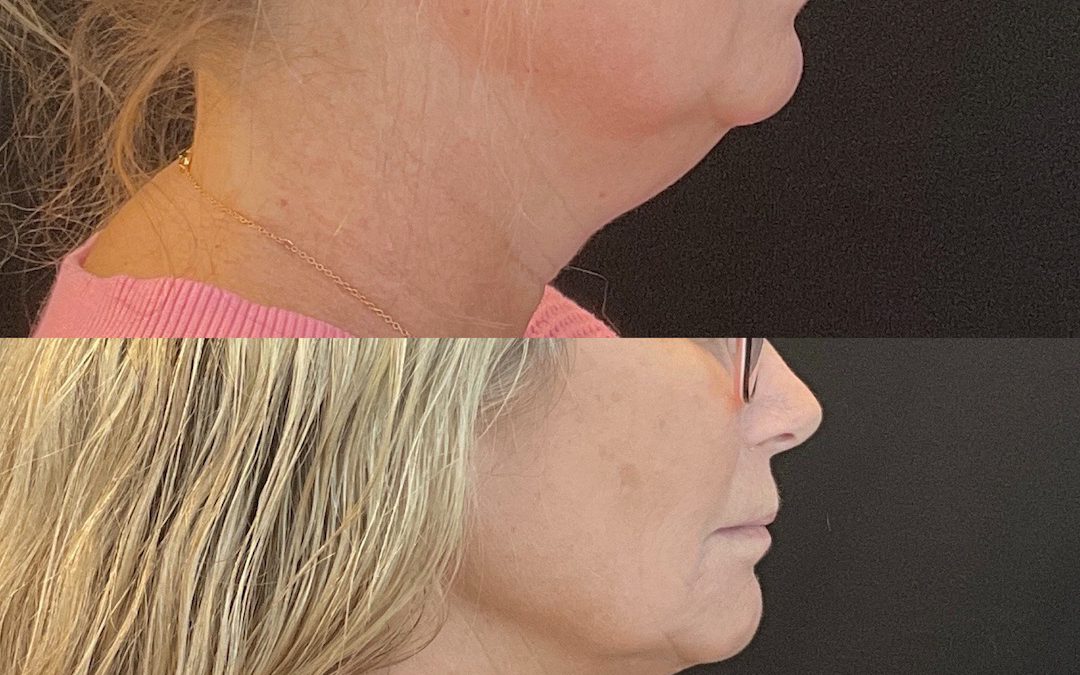 Can You Combine CoolSculpting with Other Treatments?