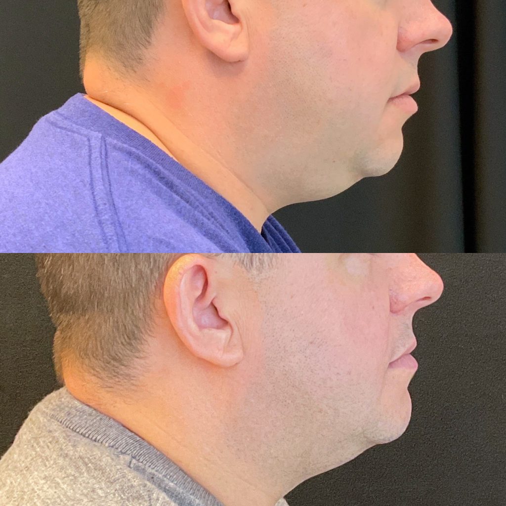 male-coolsculpting-under-the-chin