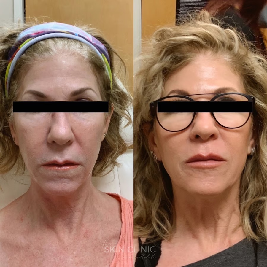 dermal-filler-juvederm-facial-rejuvination