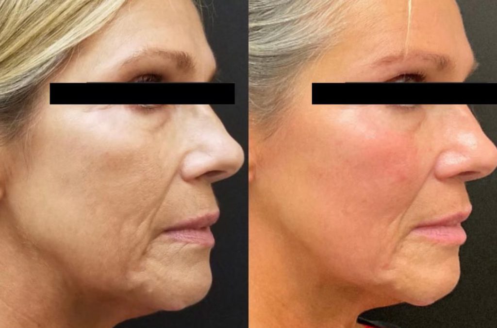 Rejuvinate Your Skin With ResurFX Laser Treatments