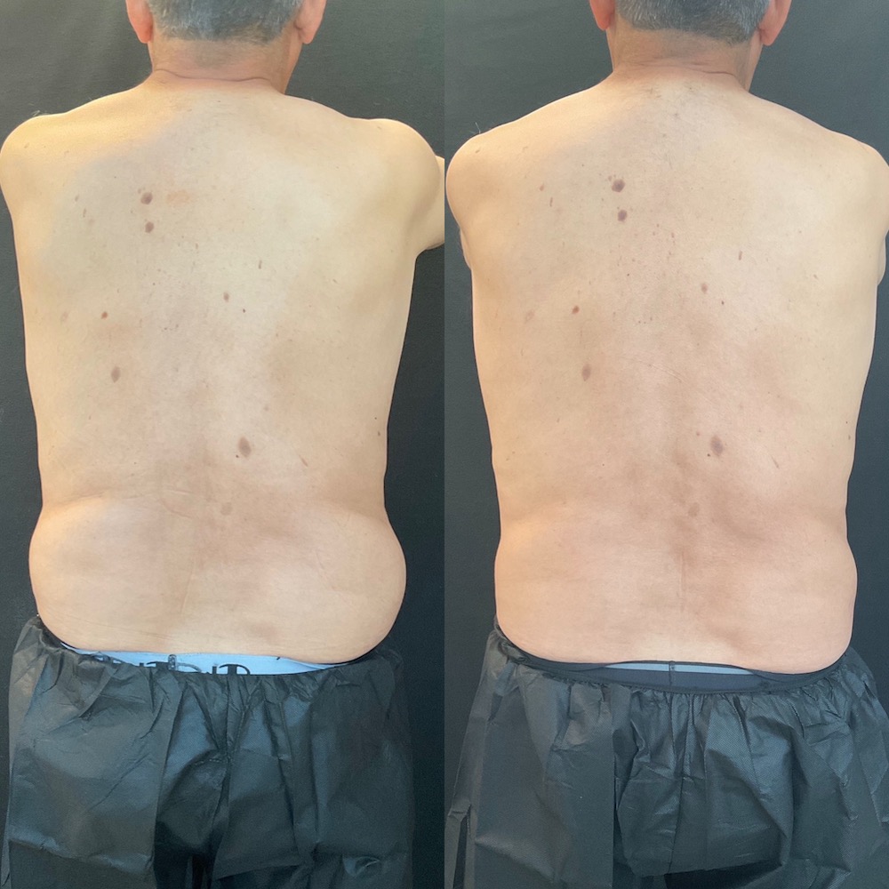 Scottsdale-coolsculpting-before-and-after