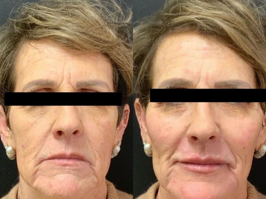 You’re Going to Love This Juvederm and DiamondGlow Facial Combo