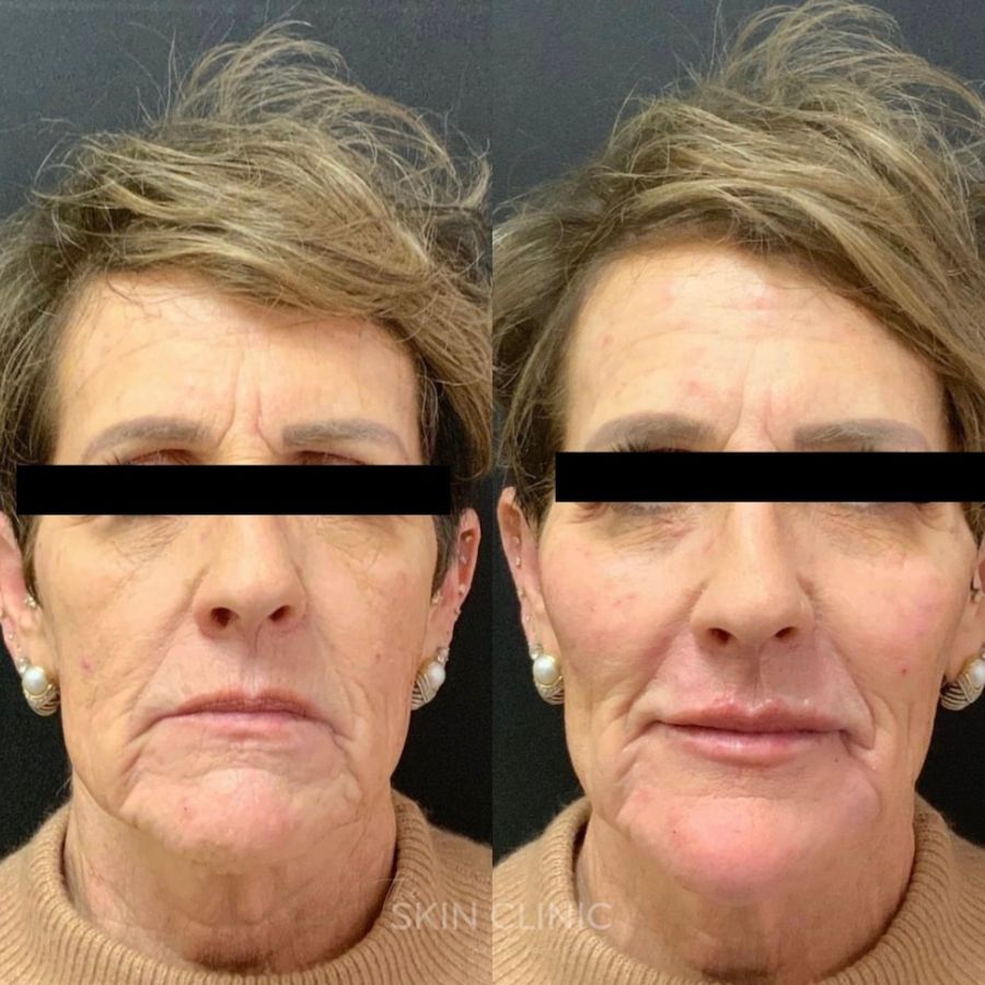 Before-and-After-Juvederm-Filler-Treatment