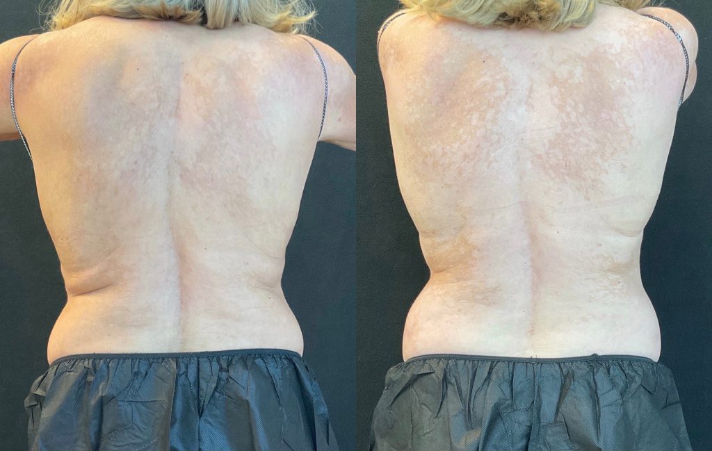 before-and-after-coolsculpting-back-fat