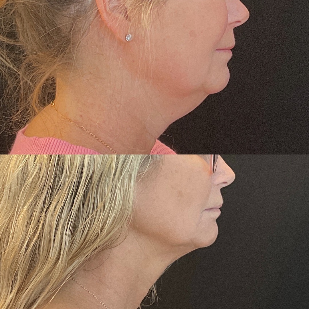 coolsculpting-under-the-chin-before-and-after