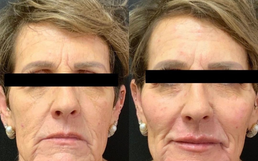 Benefits of Dermal Fillers at The Skin Clinic in Scottsdale