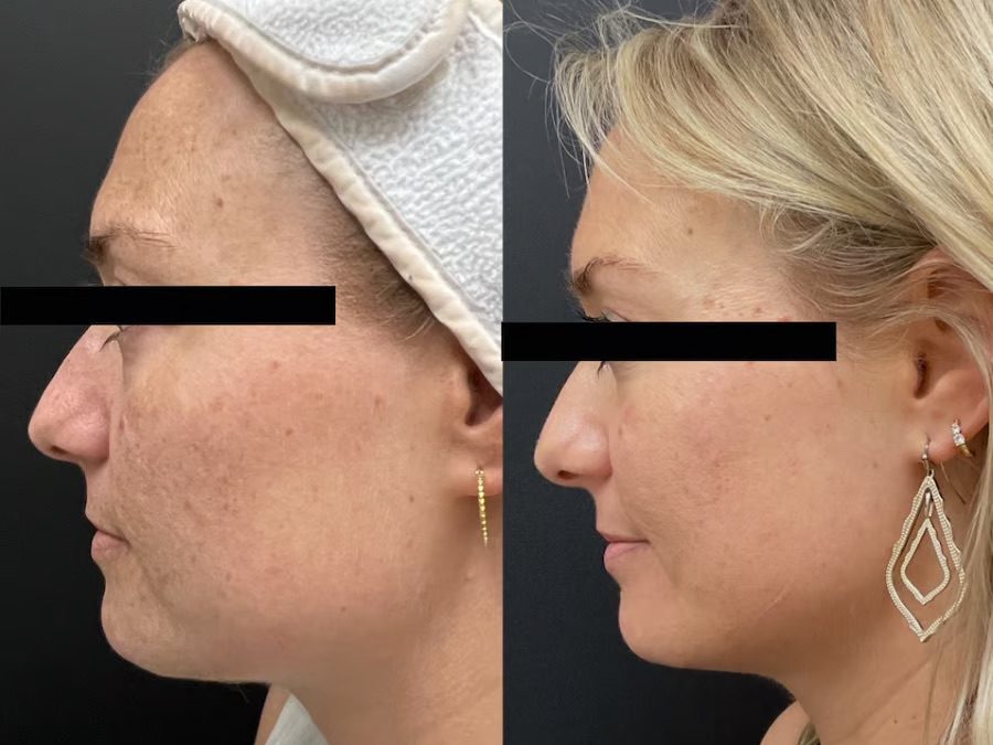 What is a Q-Switch Laser? Top Uses, Benefits & FAQs