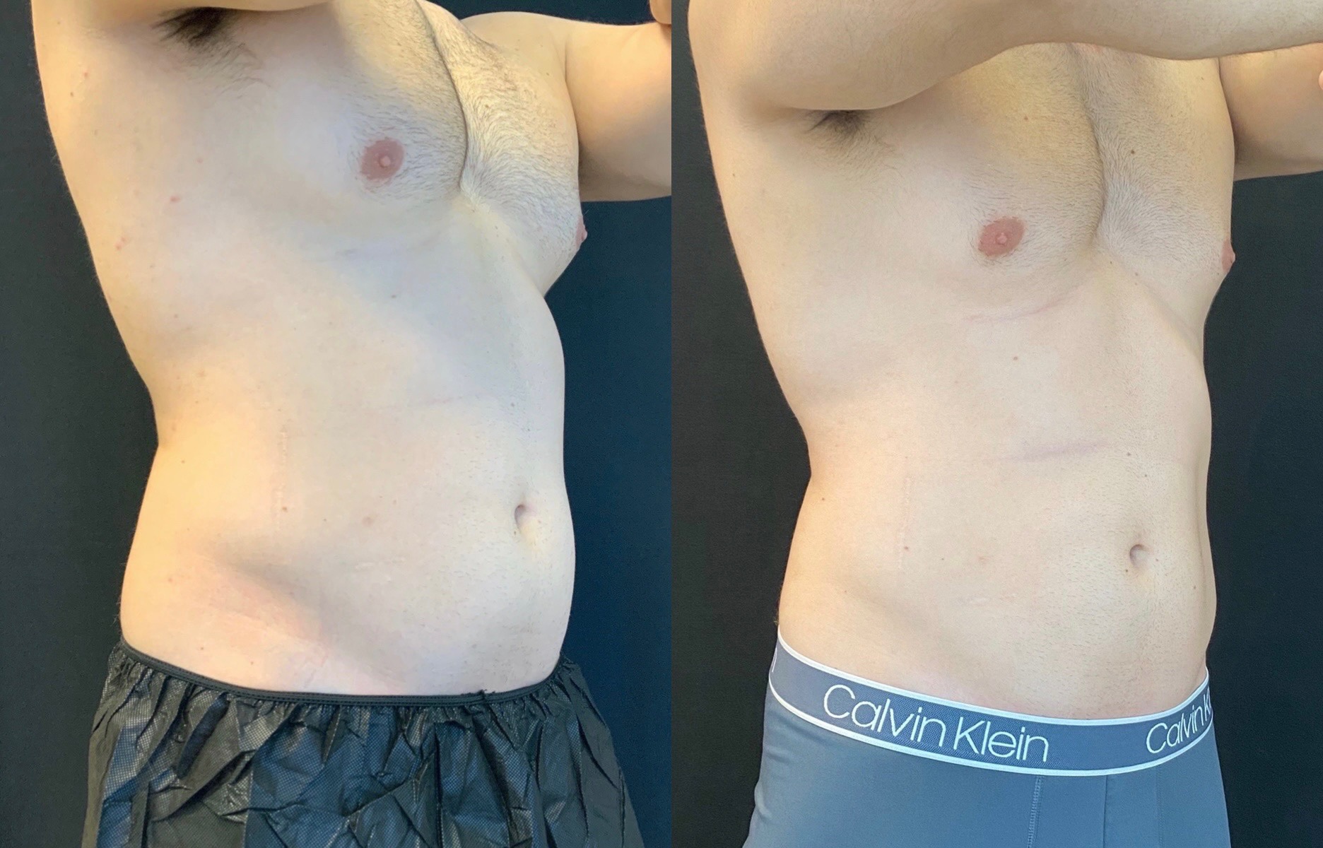 coolsculpting-fo-men-stomachbefore-and-after 