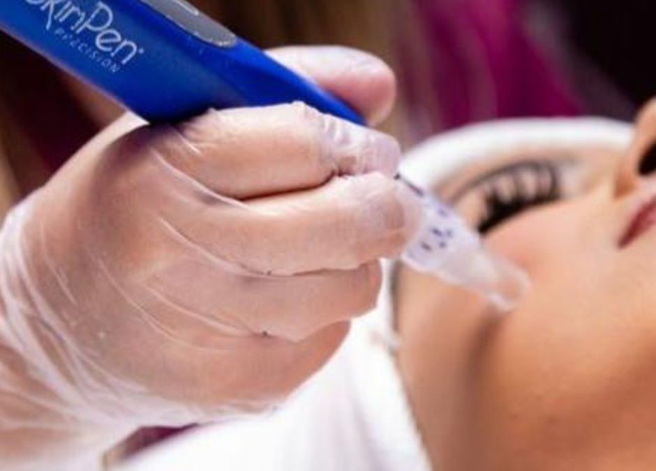 5 Benefits of SkinPen Microneedling