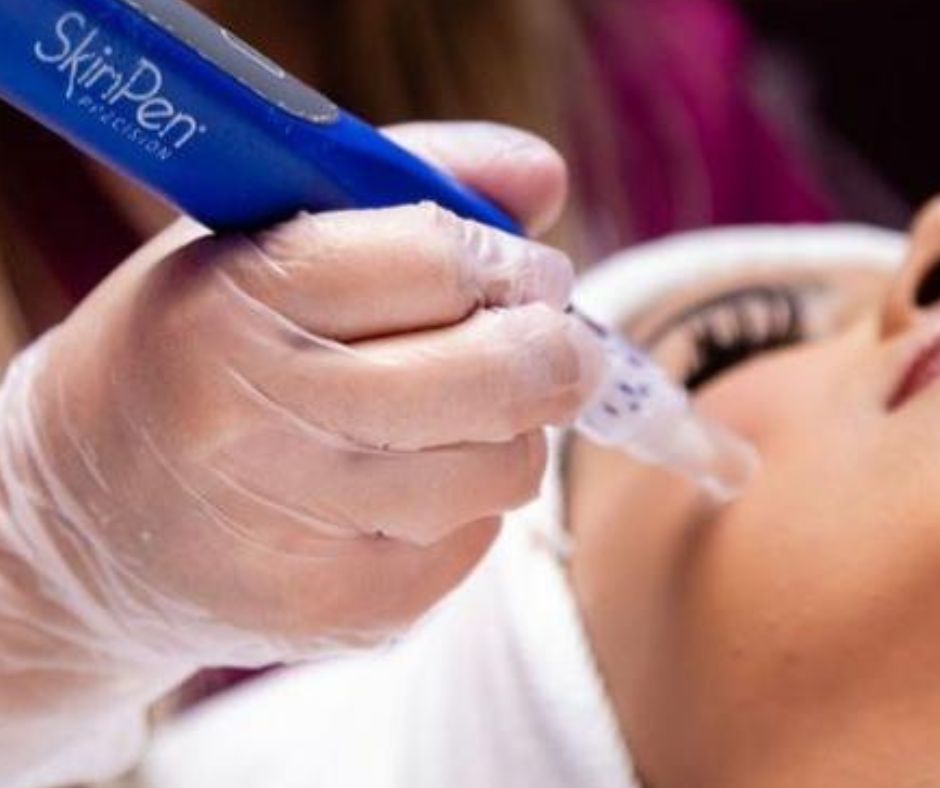skinpen-microneedling-benefits