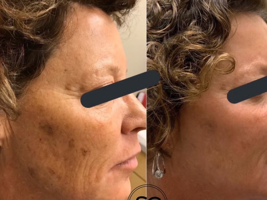 6 Benefits of Fotofacials for Brighter, Healthier, and Younger-Looking Skin