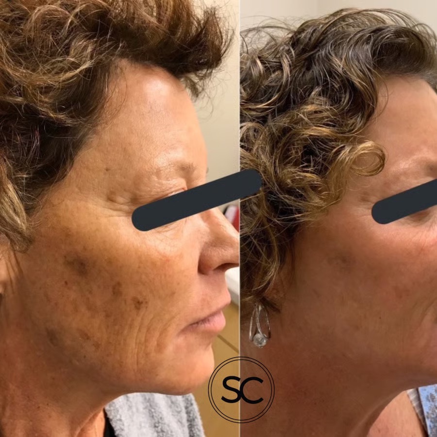 before-and-after-fotofacial-treatment-at-the-skin-clinic-scottsdale