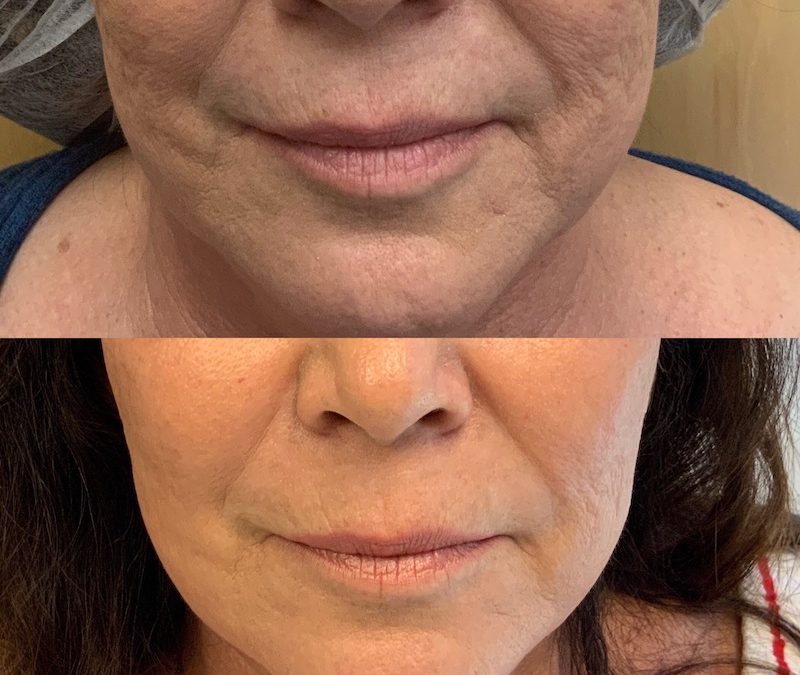 Introducing EndyMed ProMax Intensif: RF Microneedling & Fractional Skin Resurfacing