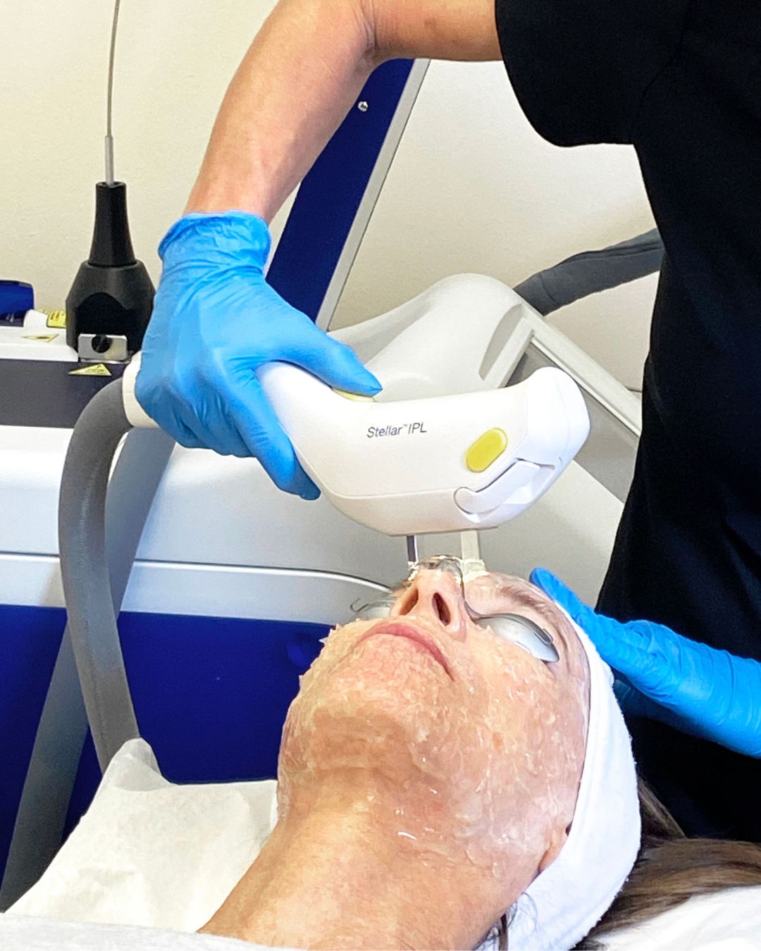 photofacial-ipl-scottsdale