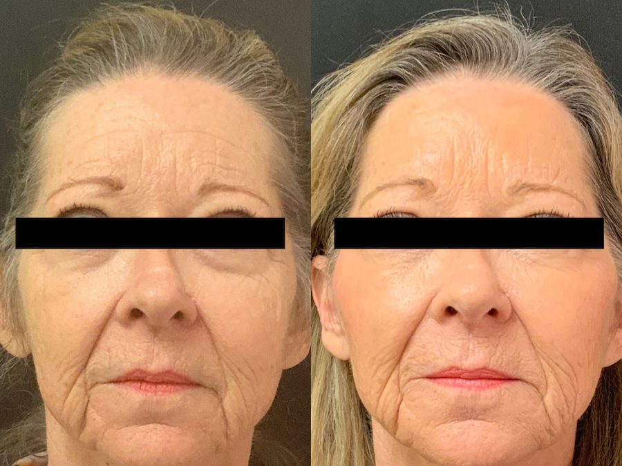 Juvederm Voluma: Lift, Contour, and Restore Volume in Your Cheeks, Chin, and Temples