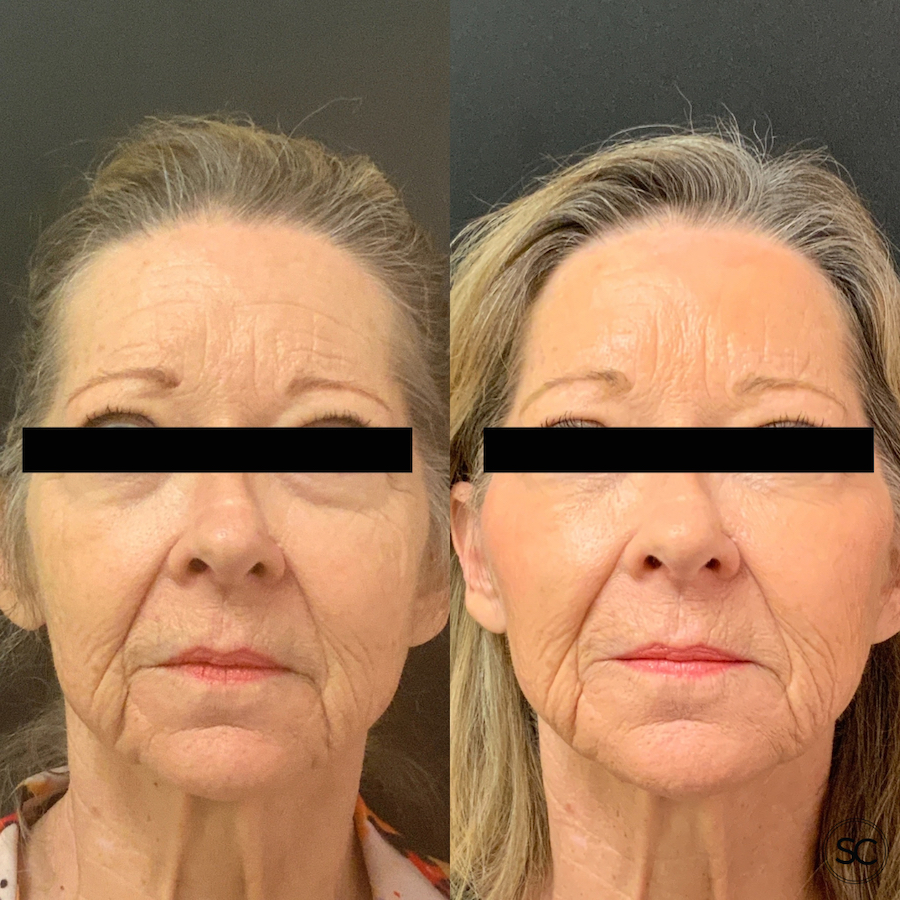 juvederm-voluma-fioller-scottsdale