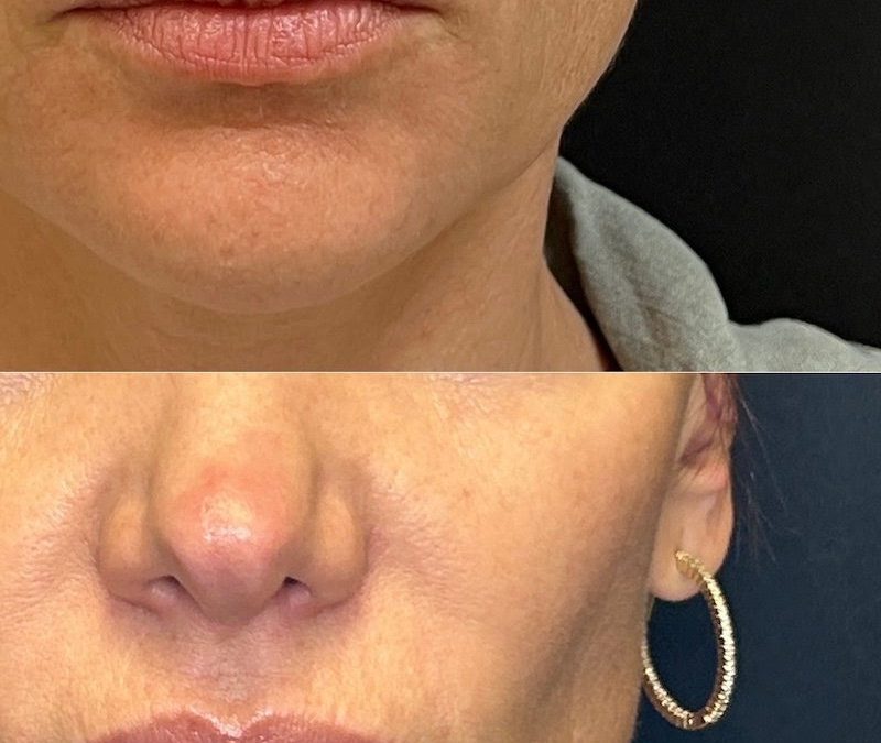 Discover the Benefits of Radio Frequency Skin Tightening for Firmer, Smoother Skin