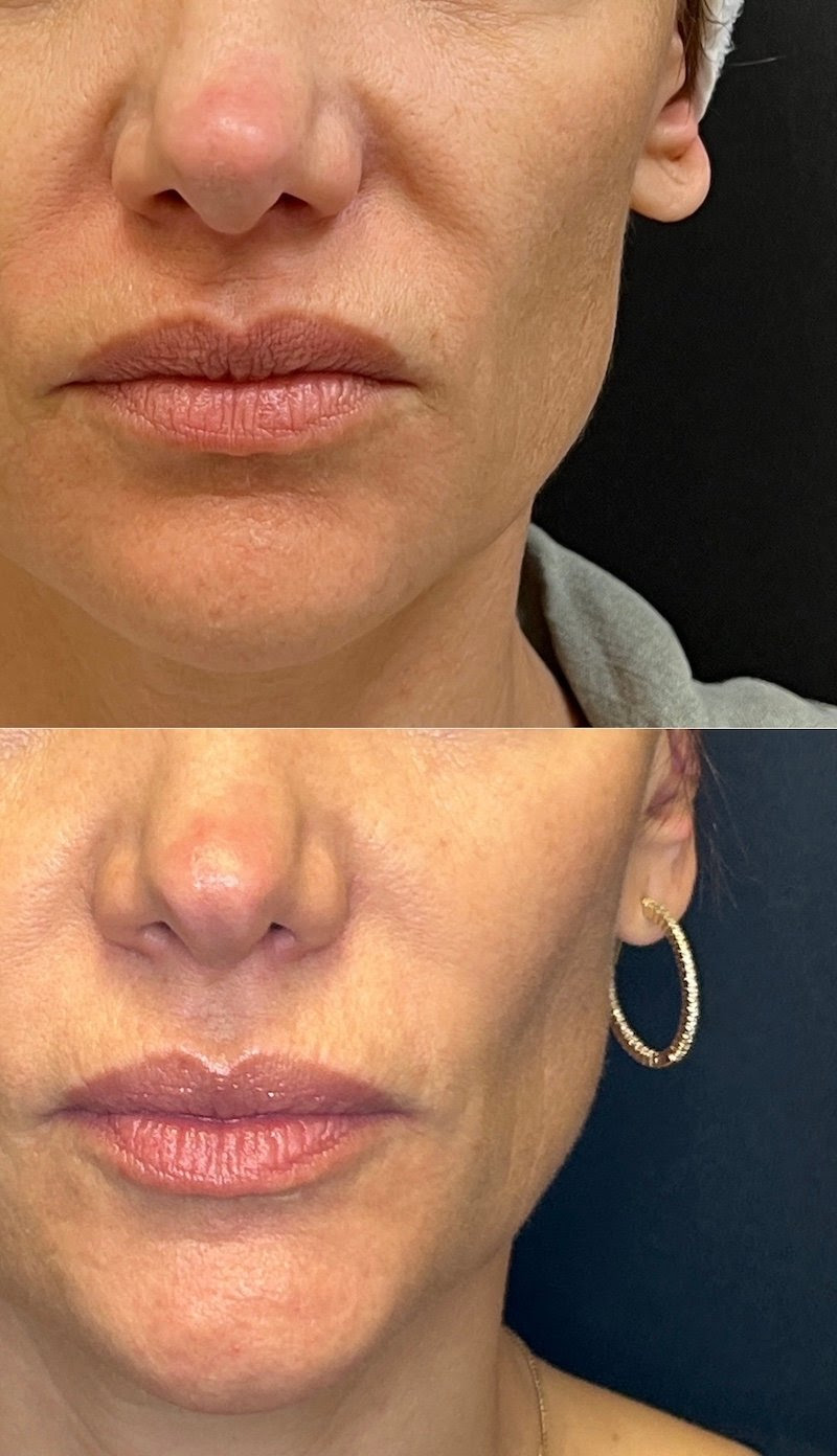 Radio-Frequency-Skin-Tightening