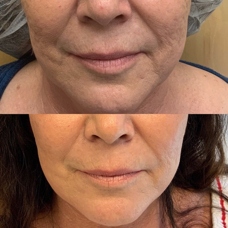 skin-tightening-with-radio-frequency