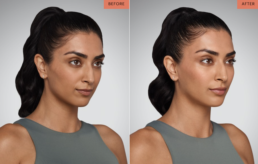 scottsdale-juvederm