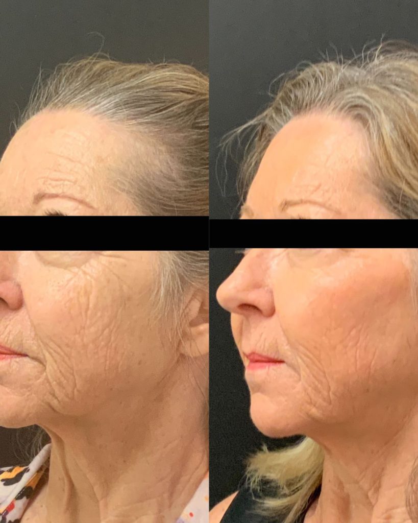 before-and-after-juvederm-fillers