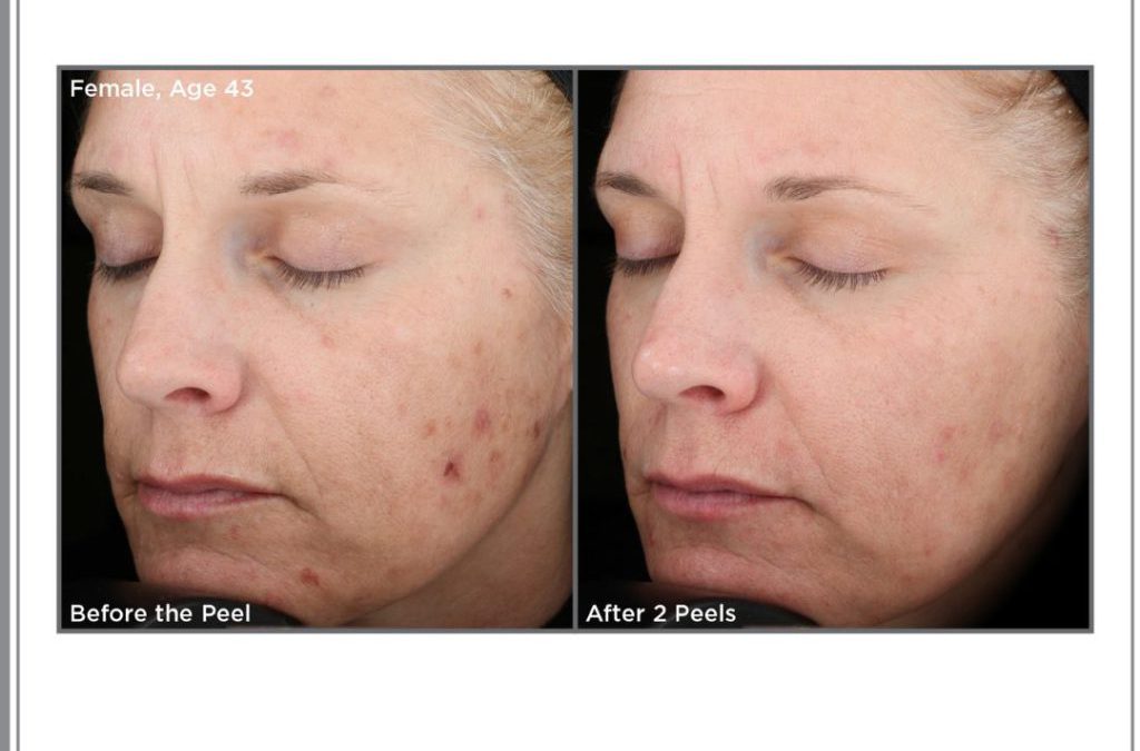 Rejuvinate Your Skin With The SkinMedica Vitalize Peel