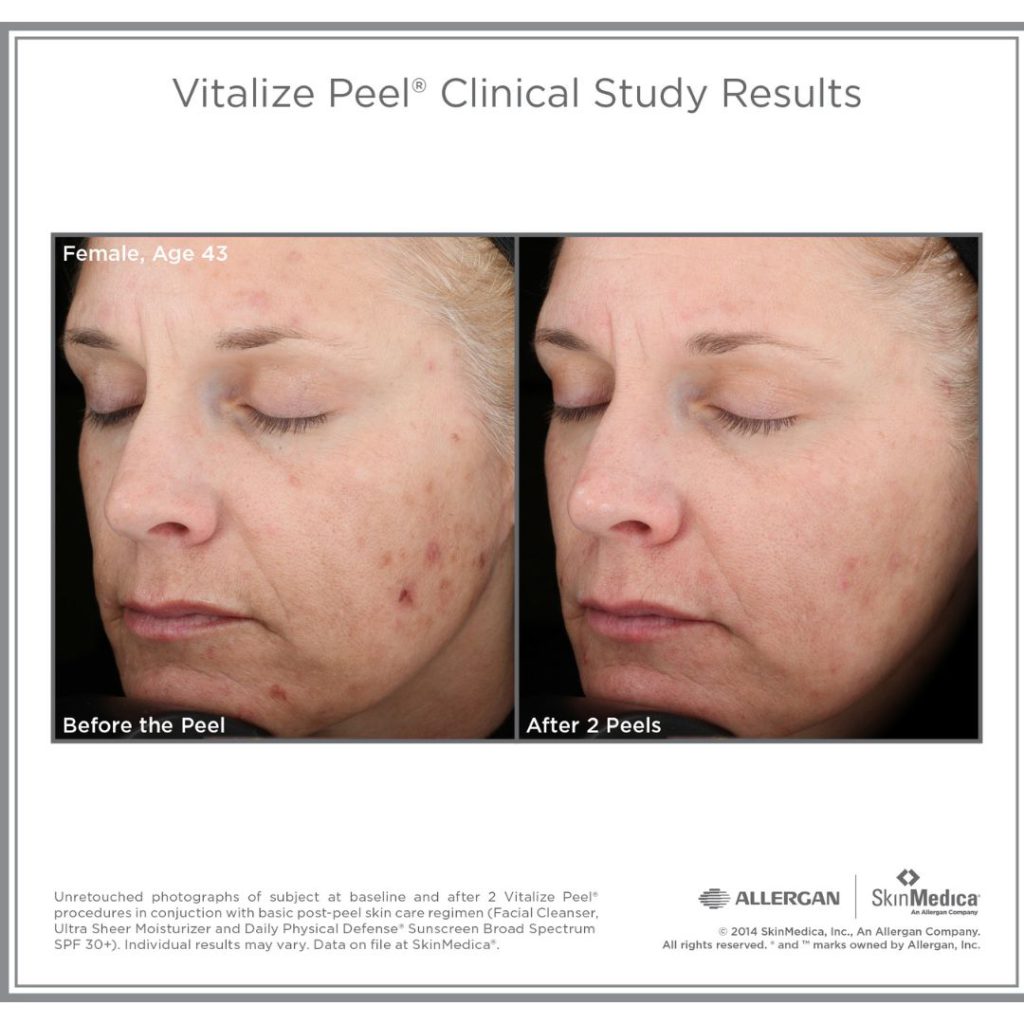 vitalize peel before and after