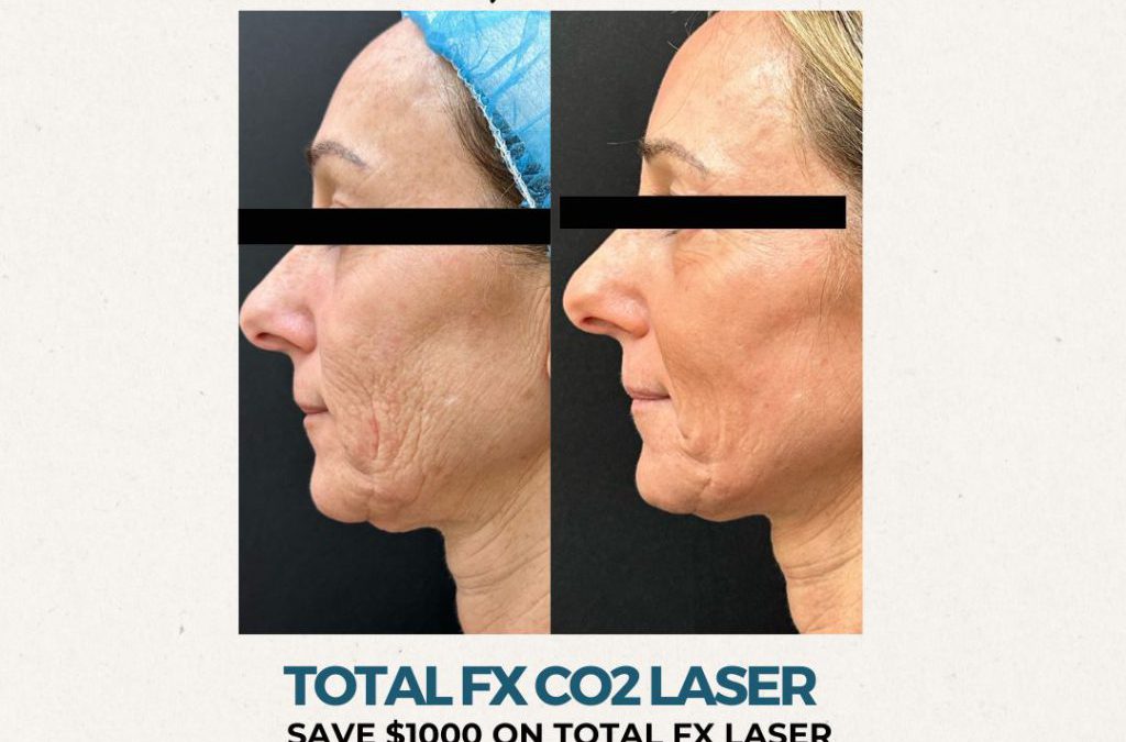 Total FX Laser Skin Resurfacing One Day Special
