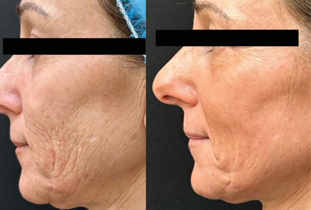 TotalFX Laser Resurfacing: Your Top Questions Answered