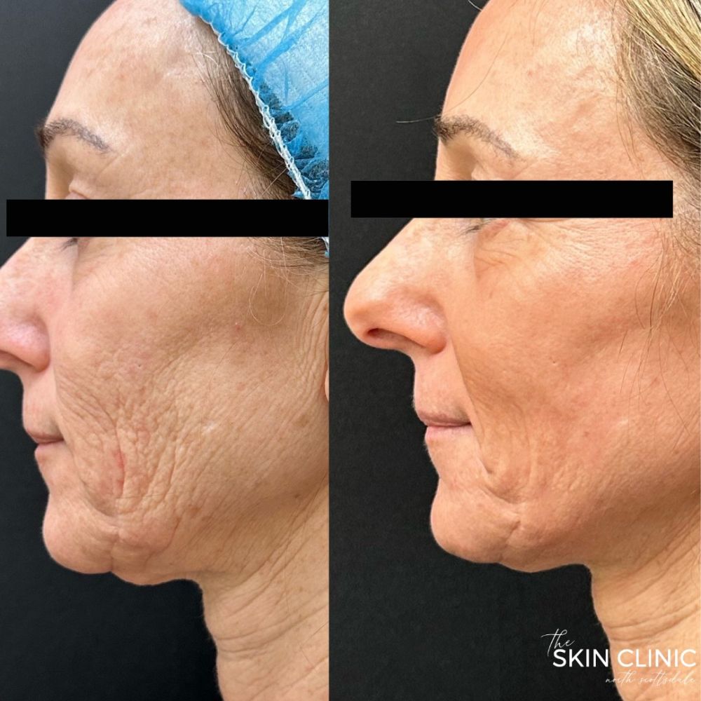 before-and-after-totalfx