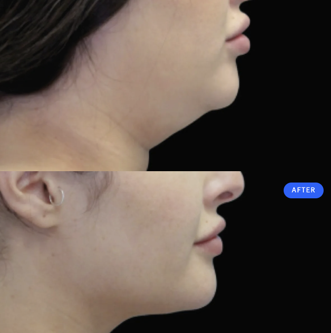 CoolSculpting for a Double Chin – Your Questions Answered