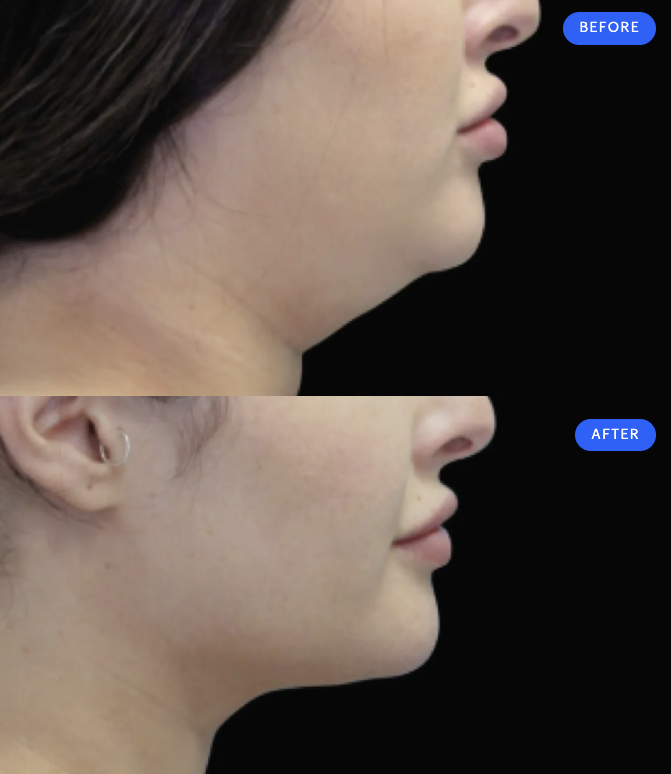 coolsculpting-under-chin-double-chin