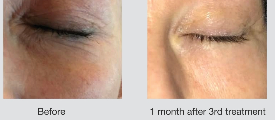 skin-resurfacing-scottsdale