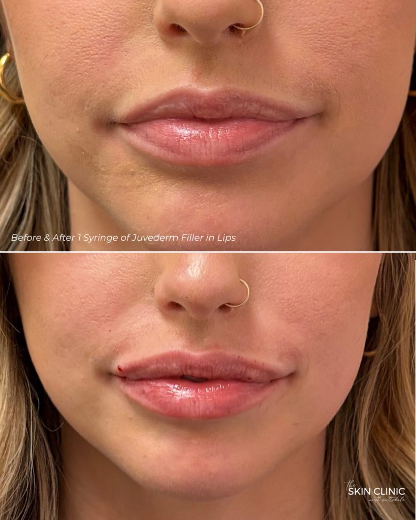 juvederm-lips-before-and-after