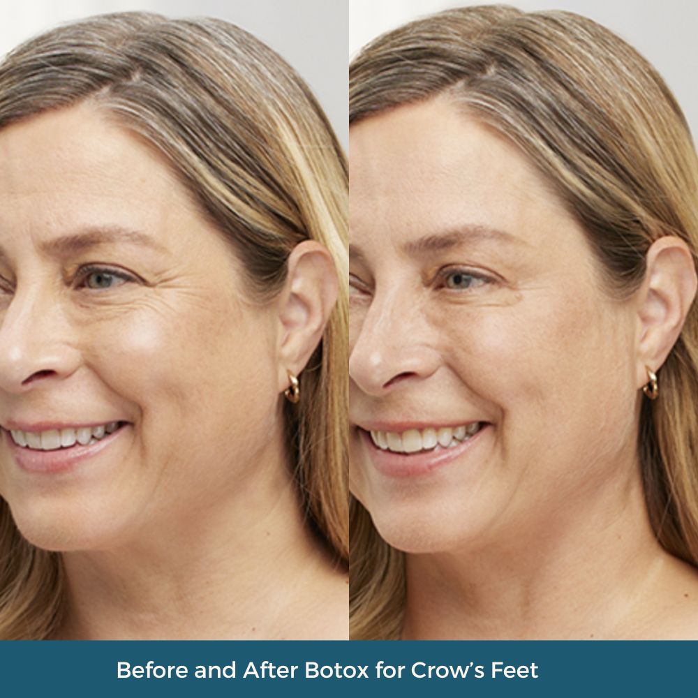 botox-for-crows-feet
