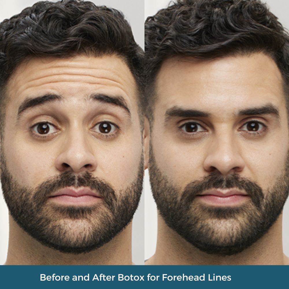 before-and-after-botox