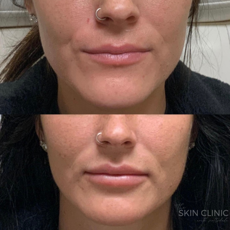 before-and-after-juvederm-in-lips