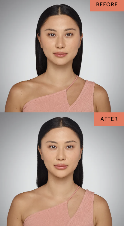 befor- and-after-juvederm