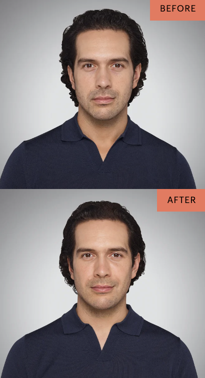 juvederm-before-and-after-results